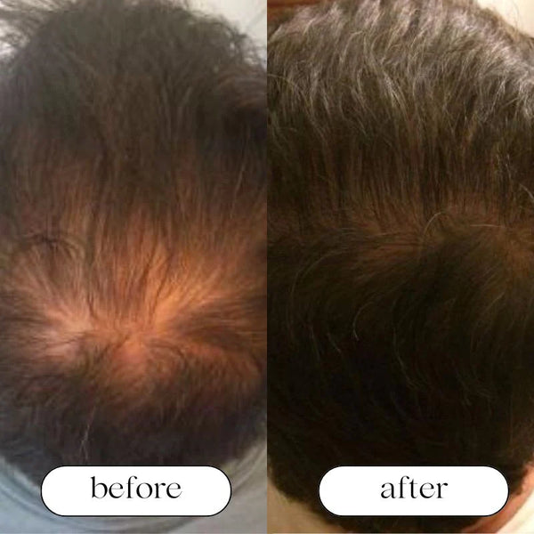 RedFuzion™ Light Therapy Hat